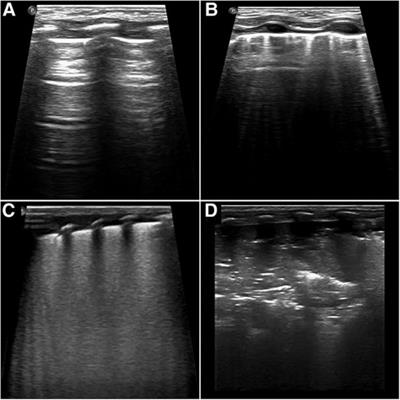 Diagnostic utility of lung ultrasound in predicting the need for surfactant therapy in preterm neonates with respiratory distress